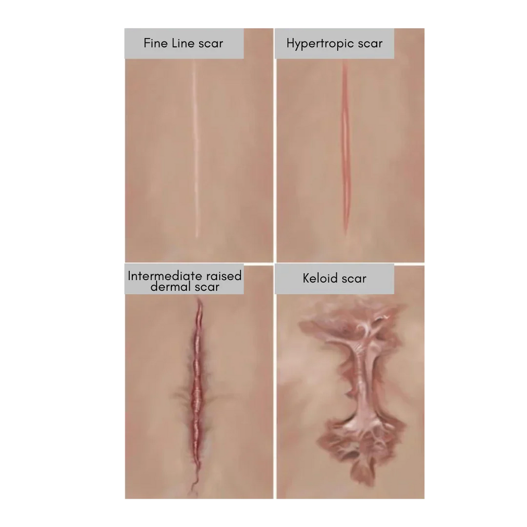What Are The Most Common Surgical Scars? (And How to Treat Them)