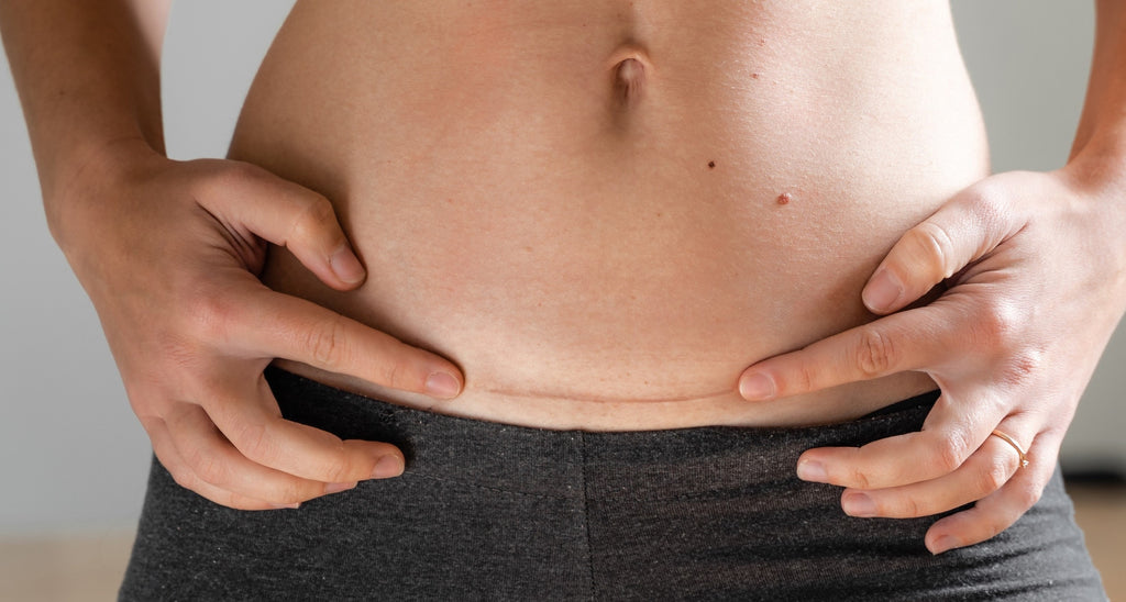 Nurturing Healing: Effective Treatment for C-Section Scars