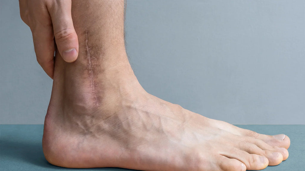 It’s Never Too Late for Scar Care - How to Improve the Look of Older Scars