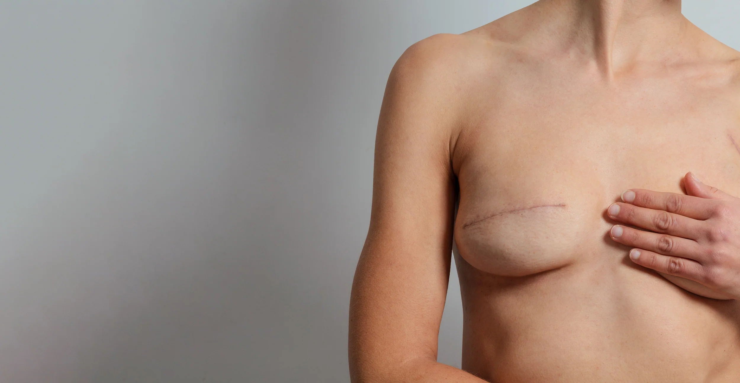 The most effective solution for treating your scars. Our Scar Heal Kits combine healthcare grade silicone sheeting & topical silicone gel to create the ideal healing environment for your scar, 24/7.