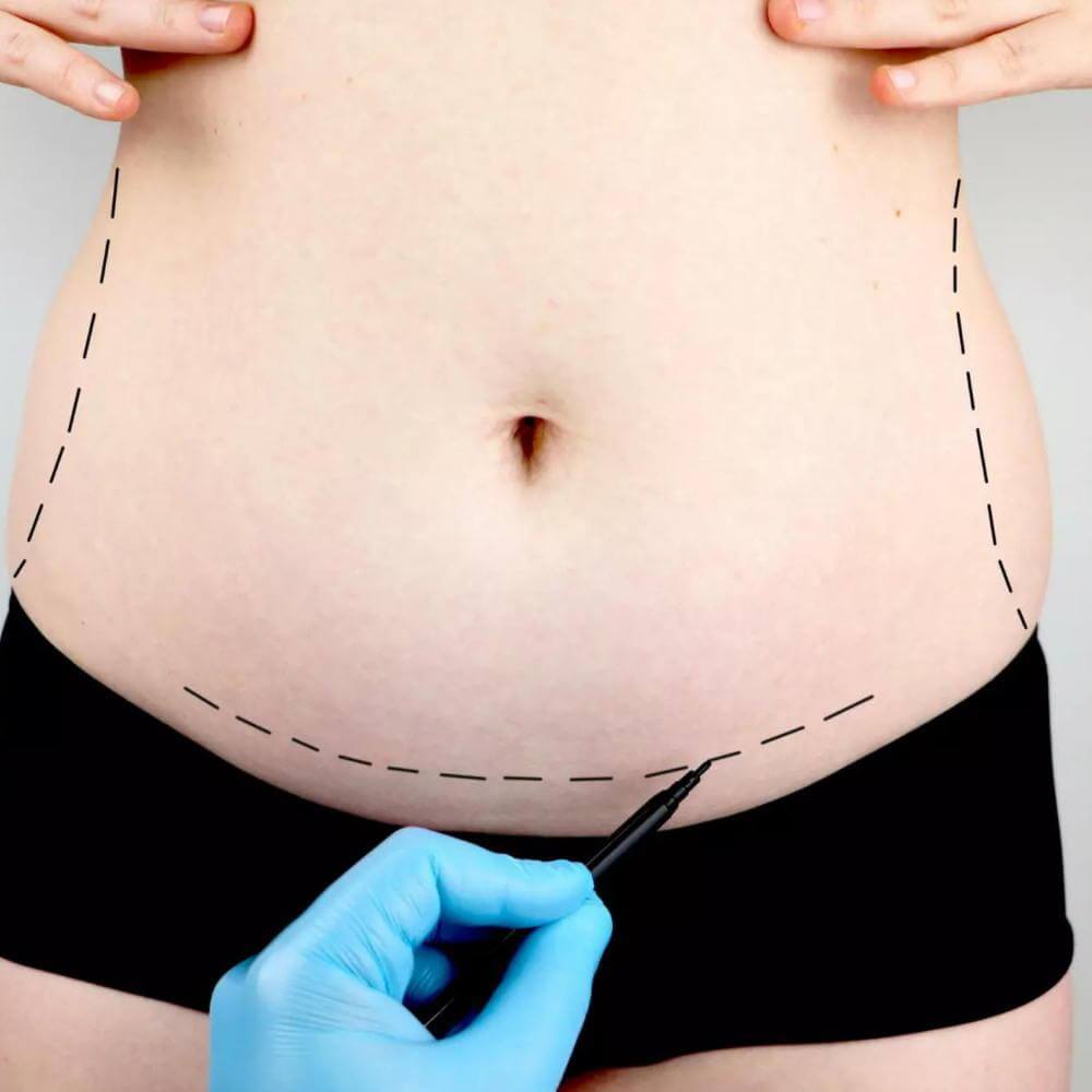 Tummy Tuck Scar Heal Kit Best Results