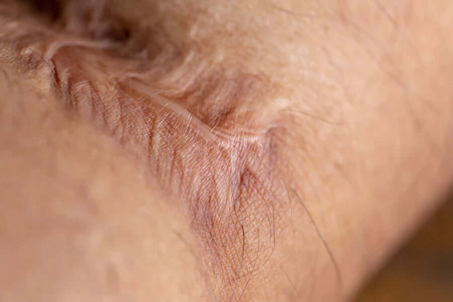 What is a Keloid Scar?