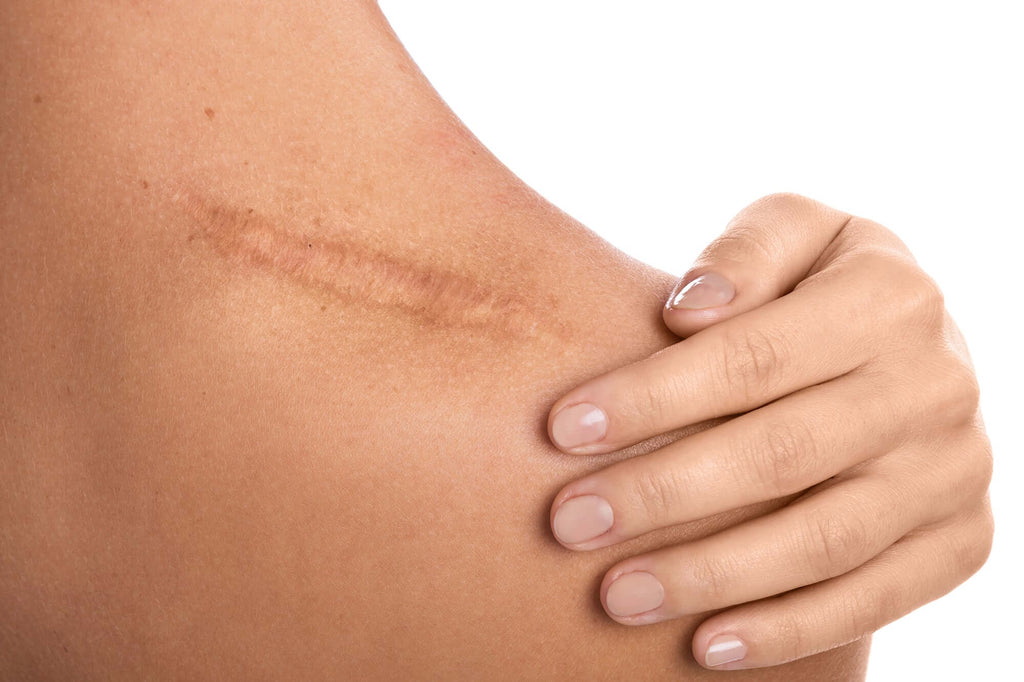 The 5 Benefits Of Scar Massage