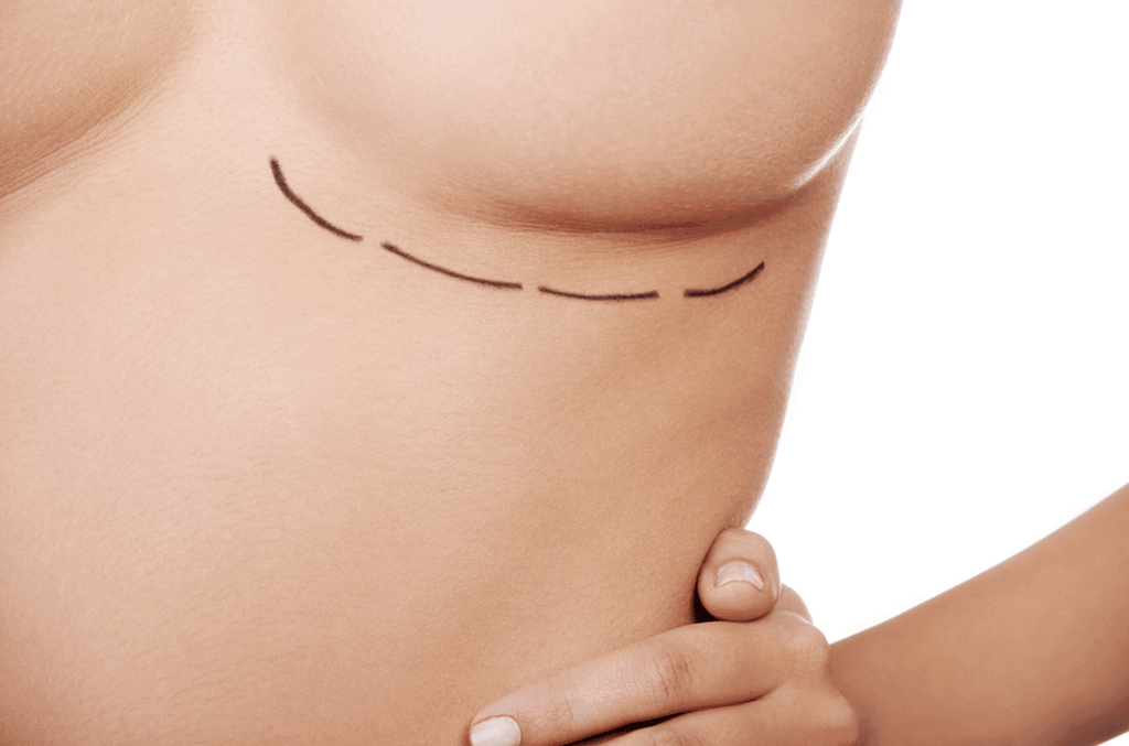 These Are 4 Things You Need To Know About Silicone Scar Sheeting For Breast Surgery