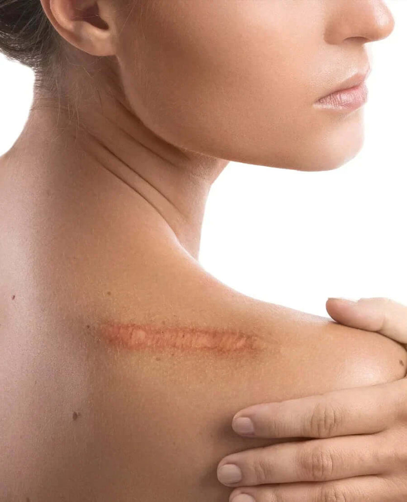 How Do Scars Form and How Can We Treat Them to Get the Best Cosmetic Outcome?