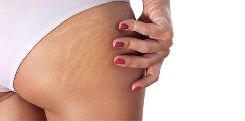 5 Things That Cause Stretch Marks (And How to Get Rid of Them)