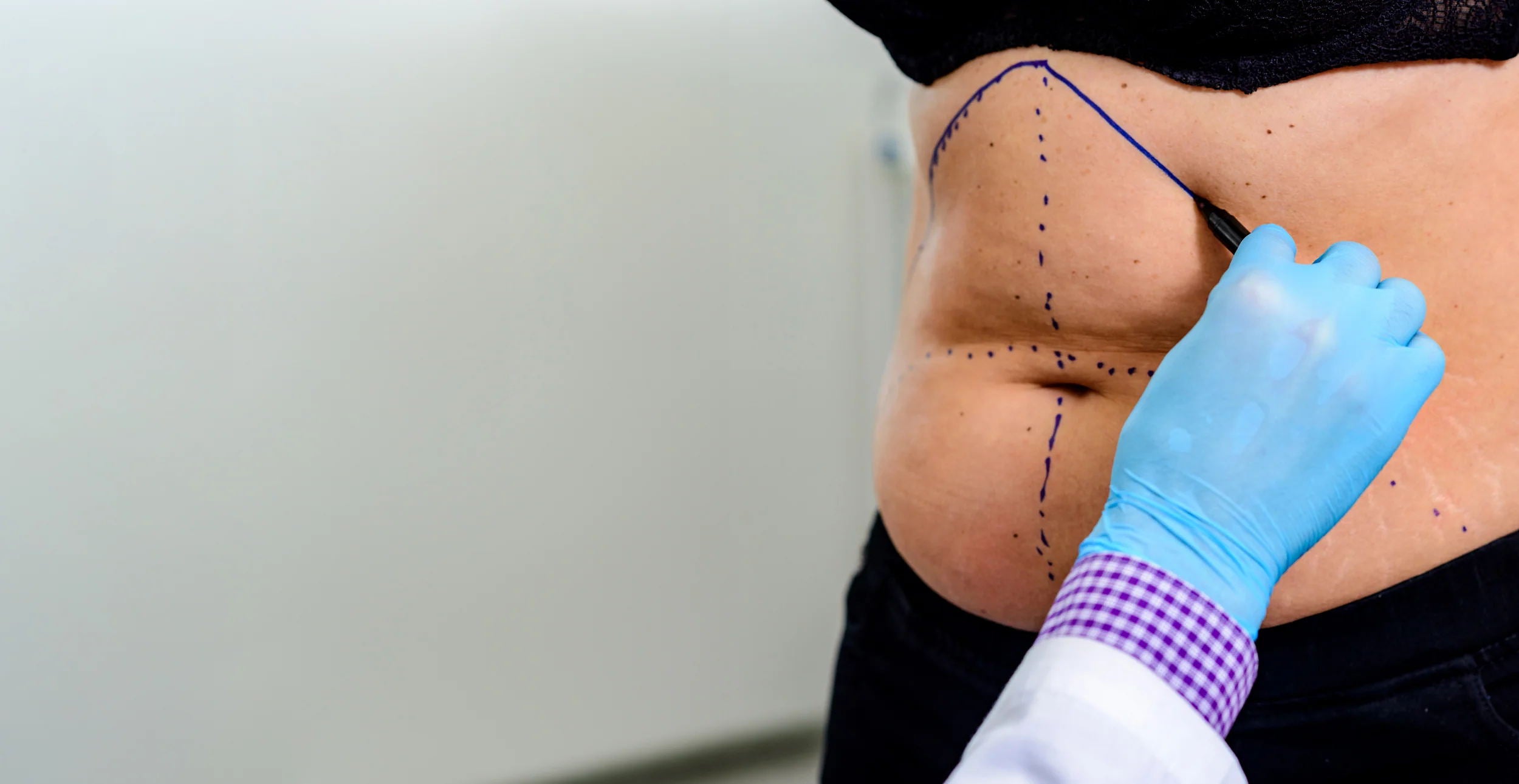 The most effective solution for treating your scars. Our Scar Heal Kits combine healthcare grade silicone sheeting & topical silicone gel to create the ideal healing environment for your scar, 24/7.