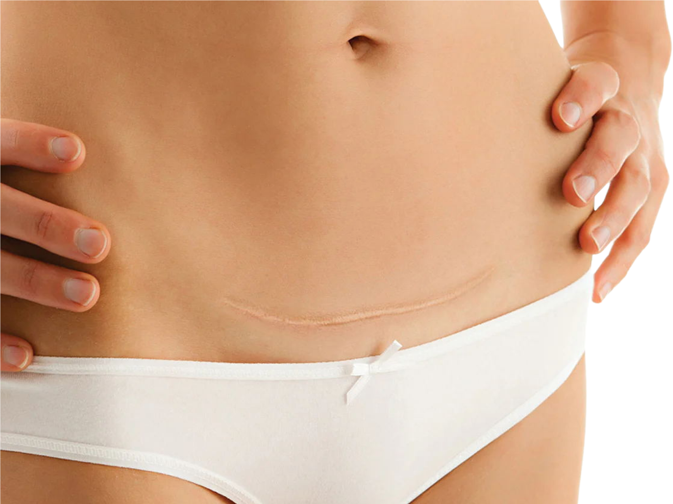 How Silicone Heals Scars