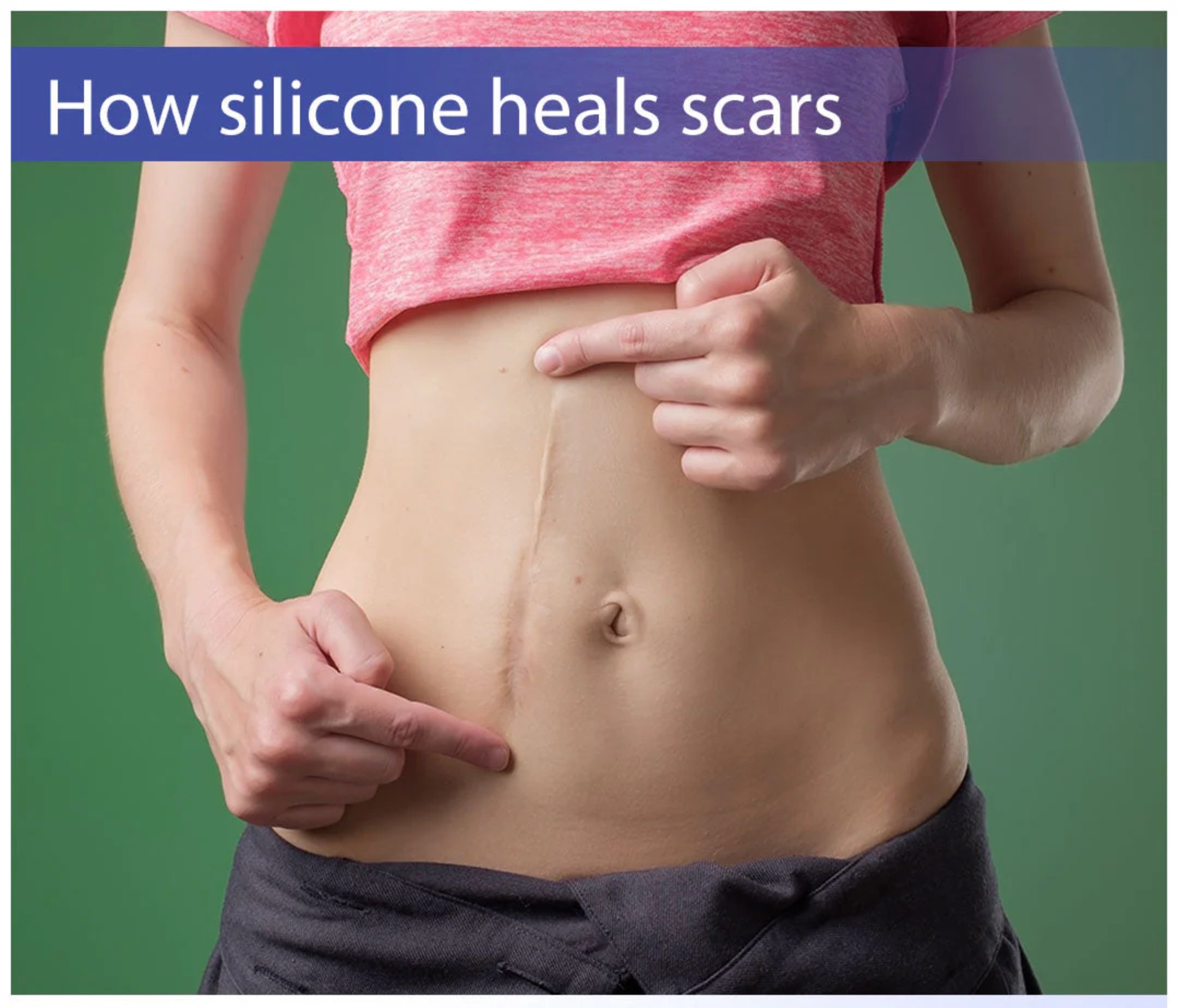 How Silicone Heals Scars