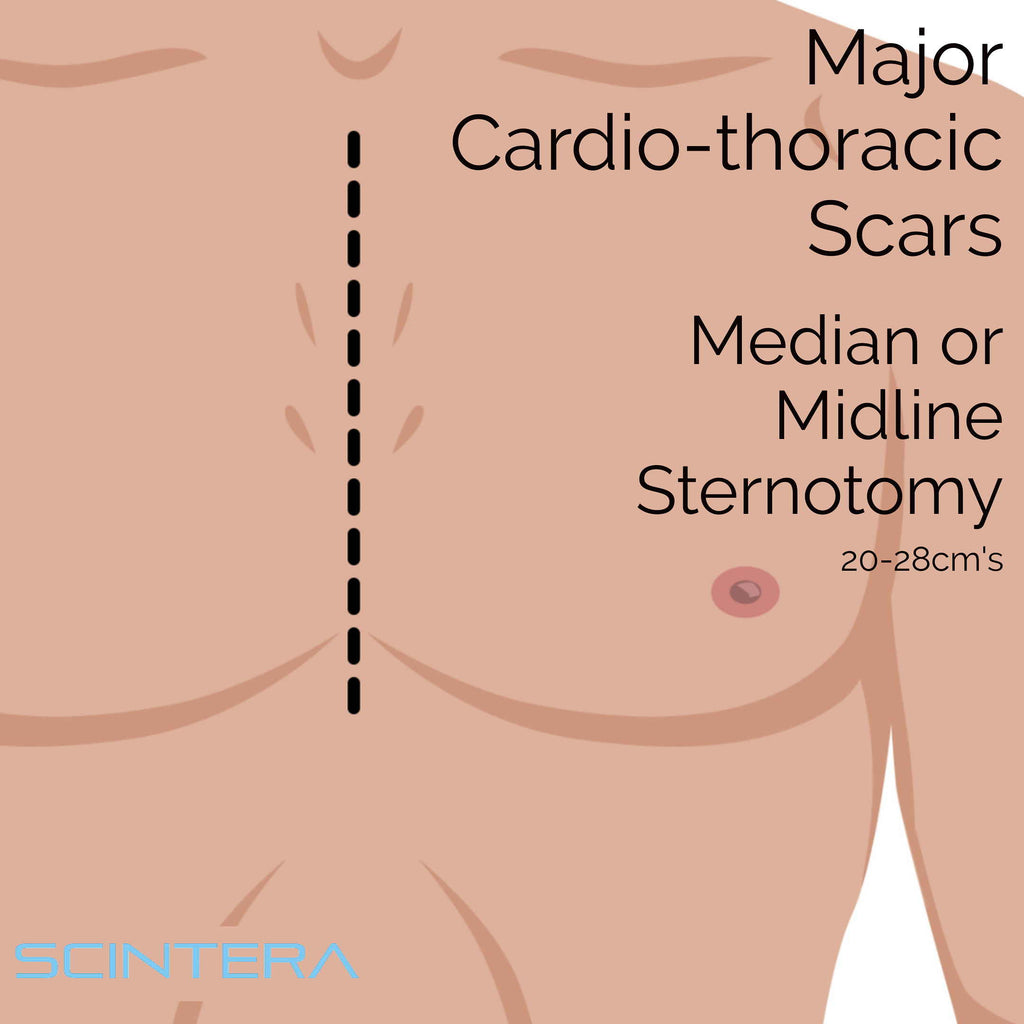 Cardiothoracic Scars
