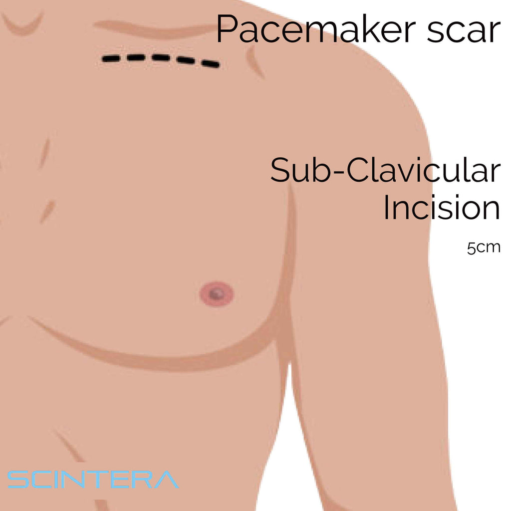 Pacemaker Scar Heal Kit