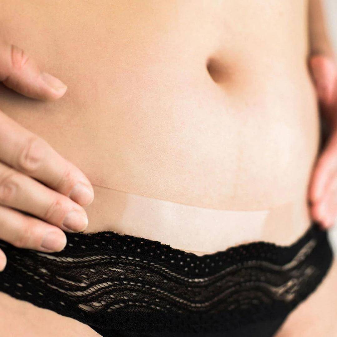 Tummy Tuck Scar Heal Kit - Scintera Pty Ltd